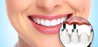 Rediscover Your Smile with Dental Implants