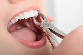 Understanding Dental Extractions