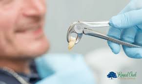 Understanding Dental Extractions: What You Need to Know